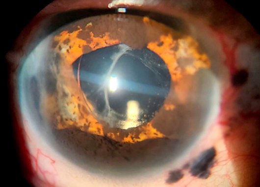 D:\Publicaciones\revista ciego\melanoma\1 copia.jpg