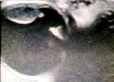 D:\Publicaciones\revista ciego\melanoma\2 usg.jpg