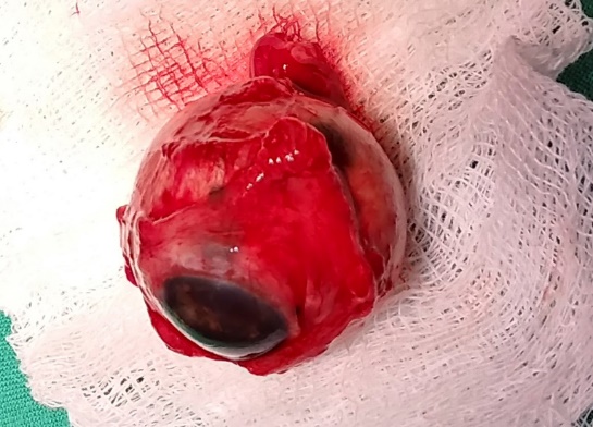 D:\Publicaciones\revista ciego\melanoma\4 enu.jpg