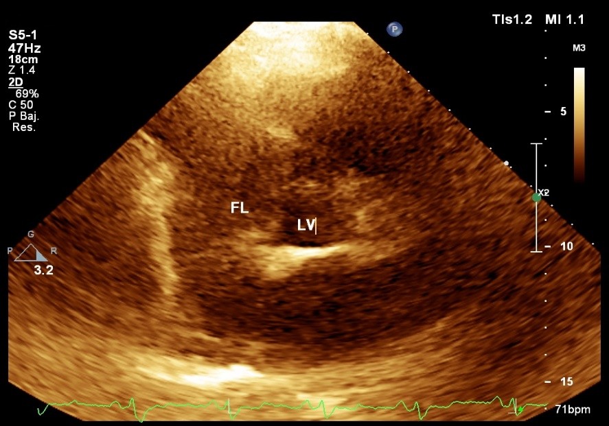 eje corto paraesternal a nivel de grandes vasos
