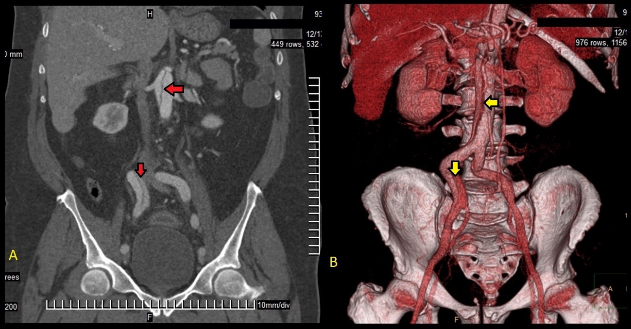 comparación de TAC de abdomen con nuclear