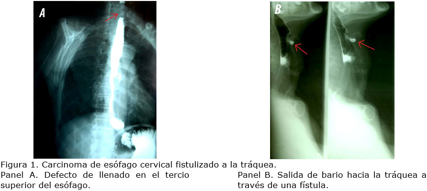 radiografía de cáncer de esófago